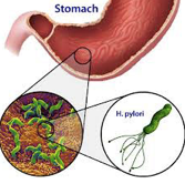 helicobakter